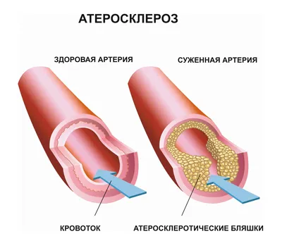 Атеросклероз сосудов (артерий) нижних конечностей (ног): лечение, симптомы,  клинические рекомендации