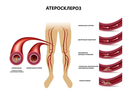 Атеросклероз сосудов (артерий) нижних конечностей (ног): лечение, симптомы,  клинические рекомендации