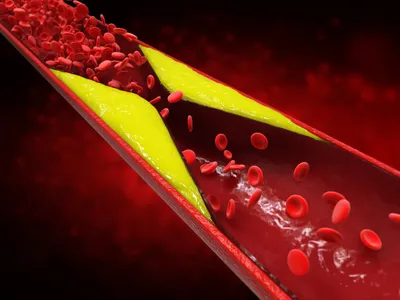 Облитерирующий атеросклероз сосудов и артерий нижних конечностей - лечение,  симптомы | ФлебоПлюс