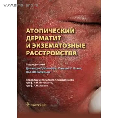 Атопический дерматит и экзематозные расстройства (5518008) - Купить по цене  от 2 412.00 руб. | Интернет магазин SIMA-LAND.RU