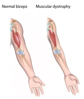 Синдром грушевидной мышцы (Piriformis syndrome, туннельная невропатия  седалищного нерва)