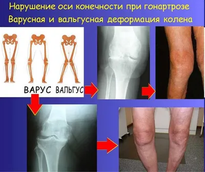 Операция по увеличению Ягодиц (Глютеопластика) в Москве