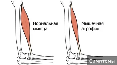 Атрофия мышц - признаки, причины, симптомы, лечение и профилактика -  iDoctor.kz