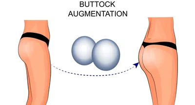 Глютеопластика - пластика ягодиц ведущим пластическим хирургом  Санкт-Петербурга