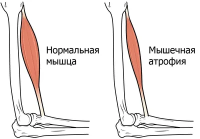 Атрофия мышц ног фотографии