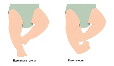 Тейпирование пальцев ног при когтистой деформации | Академия ТТ