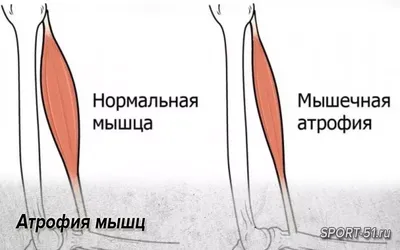 Миозит мышц рук: причины, симптомы, лечение - Доктор Позвонков