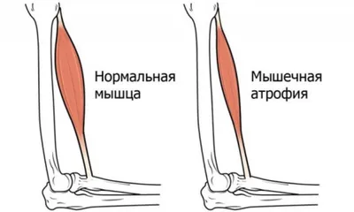 Спинальная мышечная атрофия: полезная информация о СМА