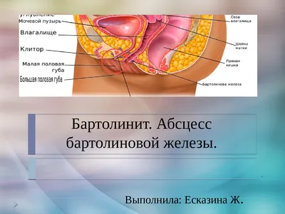 Бартолинит. Абсцесс бартолиновой железы. | Презентации Акушерство и  гинекология | Docsity