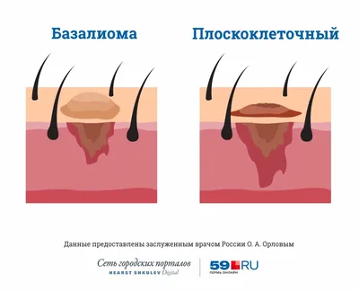 Как отличить рака кожи от меланомы — фото с примерами и рекомендации  онколога - 15 февраля 2019 - ufa1.ru