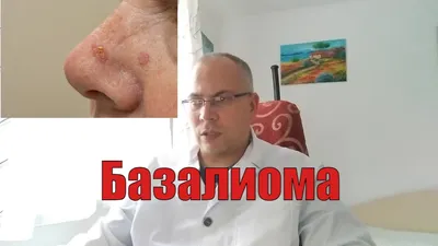 Базалиома - видео о базальноклеточном раке кожи - YouTube