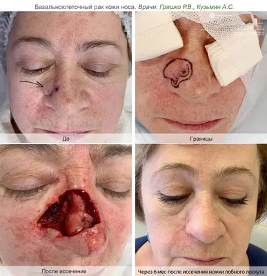 Лечение базалиомы кожи лазером в клинике лазерной хирургии и косметологии  «Градиент»