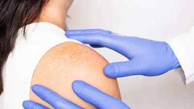 Будьте внимательны: ТОП-7 самых неочевидных признаков рака кожи