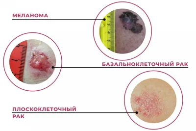 Прыщ или базалиома: рассказываем о самом распространённом раке кожи
