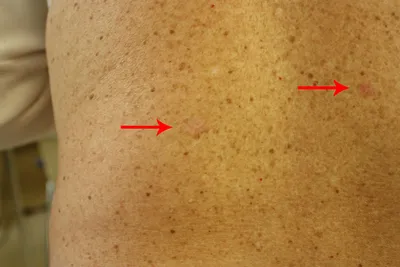Базальноклеточный рак кожи — Портал о меланоме