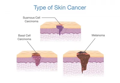 Базальноклеточный рак кожи
