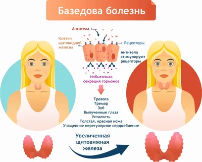 Диффузный токсический зоб (болезнь Грейвса-Базедова, ДТЗ) у детей -  лечение, симптомы