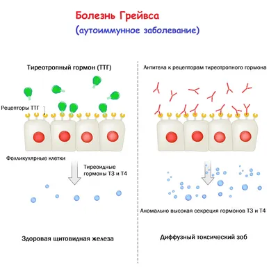 Болезнь Грейвса (диффузный токсический зоб (болезнь Базедова) - причины  появления, симптомы заболевания, диагностика и способы лечения