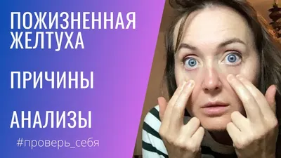 Почему желтеют белки глаз и что с этим делать - Будь здорова! - WomanHit.ru