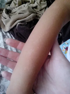У ребенка скопление маленьких белых пятен на коже - Вопрос дерматологу - 03  Онлайн