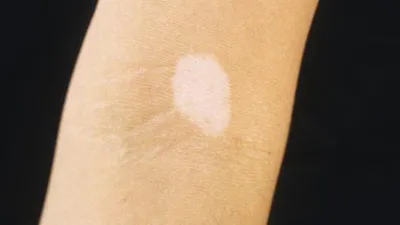 Ученые выяснили, почему «болезнь белых пятен» спасает от рака кожи -  Индикатор