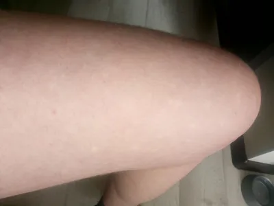 Белые пятна на коже рук и ног - Вопрос дерматологу - 03 Онлайн