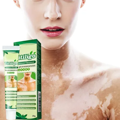Крем для ухода за товаром Vitiligo, крем для темных точек, уменьшает белые  пятна на коже, питательные ингредиенты, терапевтический леукоплакийный  s-крем - купить по выгодной цене | AliExpress