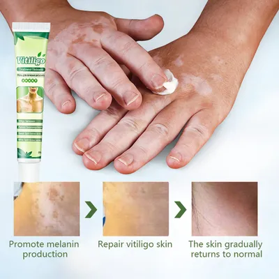 Крем для ухода за товаром Vitiligo, крем для темных точек, уменьшает белые  пятна на коже, питательные ингредиенты, терапевтический леукоплакийный  s-крем - купить по выгодной цене | AliExpress