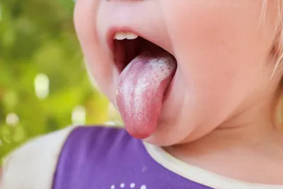 Белый налёт на языке у ребёнка ✔️ Причины, симптомы и лечение | \