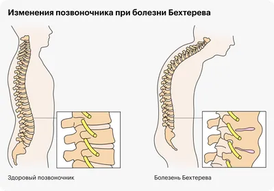 Повернуться в кровати было подвигом»: как я живу с болезнью Бехтерева