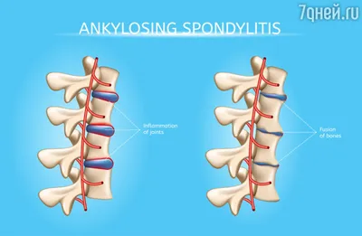 Как диагностируют и лечат болезнь Бехтерева - 7Дней.ру