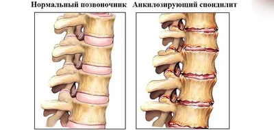 Лечебная физкультура (ЛФК) при болезни Бехтерева