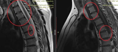 Болезнь бамбукового позвоночника или болезнь Бехтерева + клинический случай  с МРТ-картинками | Пикабу