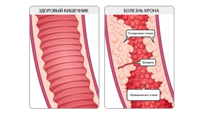 Болезнь Крона: симптомы, лечение, осложнения, диагностика у взрослых