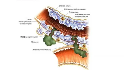 Болезнь Крона: симптомы, лечение, осложнения, диагностика у взрослых