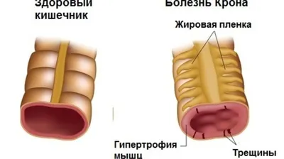 Лечение болезни Крона в Екатеринбурге - Новая больница