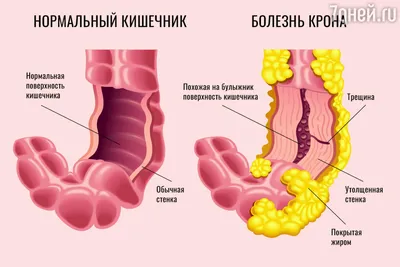 Болезнь Крона и язвенный колит: что такое воспалительные заболевания  кишечника - 7Дней.ру
