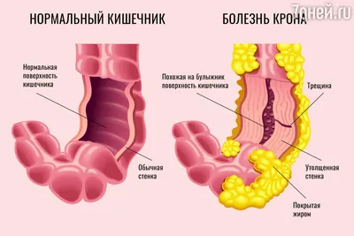 Болезнь крона фото