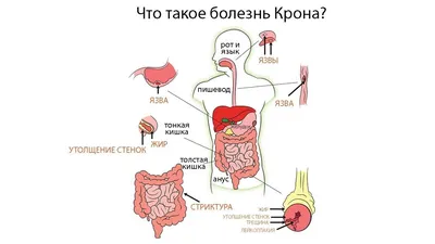 Болезнь Крона: симптомы, лечение, осложнения, диагностика у взрослых