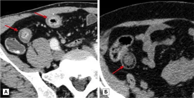 Computer tomography in the diagnosis of small bowel diseases - Koshelev -  Journal of Clinical Practice