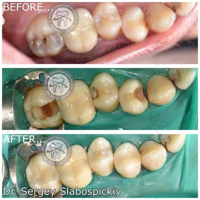 Болезни Зубов [9 Фото] Лечение Киев ЛюмиДент