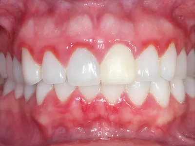 Лечение десен зубов - цена | Лечение парадонтоза в Сургуте