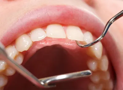 Цена лечения десен зубов в Москве | Стоимость лечения десен в стоматологии  Deva-Dent