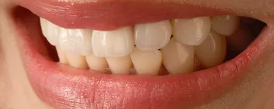 Чем опасно для зубов длительное ношение маски, рассказал стоматолог