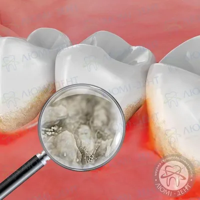 Лечение Десен Народными Средствами [Чем Лечить] Как Вылечить Дома В  Домашних Условиях Киев ЛюмиДент