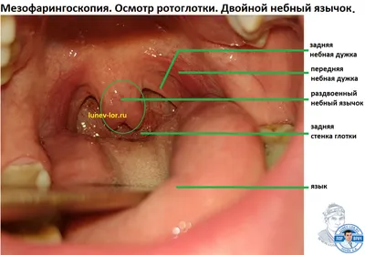 Фарингит - фото - ЛОР в Самаре - врач Лунёв Андрей Владимирович