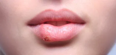 Болезни губ у взрослых и детей: причины, симптомы и лечение заболеваний губ