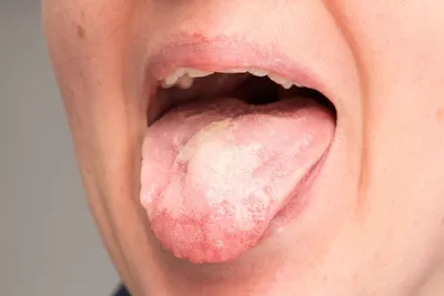 Болезни… языка! Что может вылечить стоматолог?