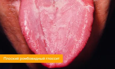 Ромбовидный глоссит — признаки, фото, лечение, уход за языком в статье  Startsmile.ru