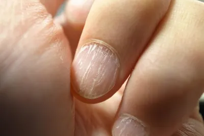 Гапалонихия – симптомы, причины, виды, способы лечения и профилактики  размягчения ногтей